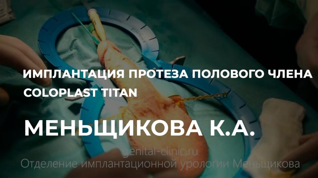 Имплантация протеза Coloplast Titan