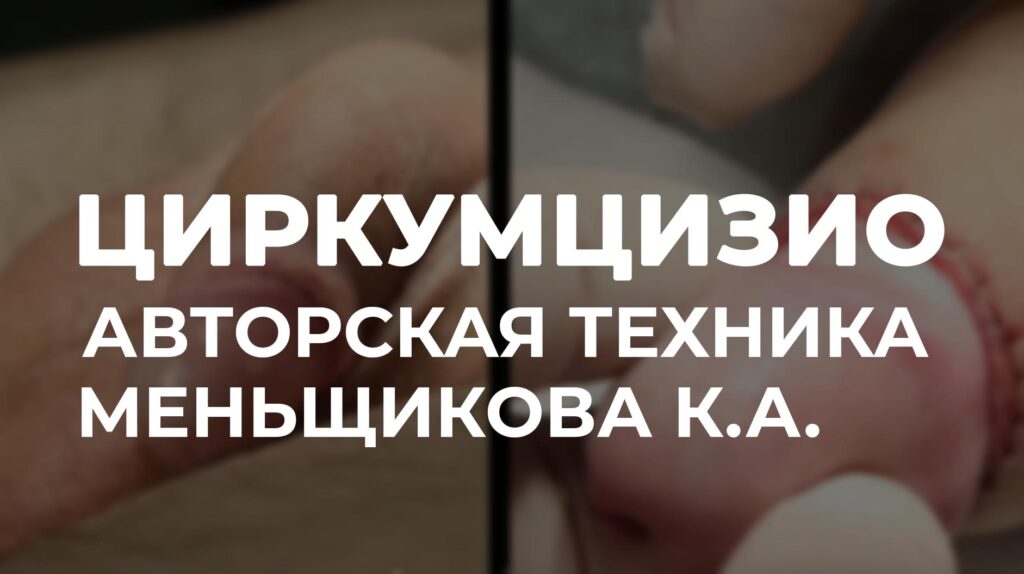 церкумзио видео операции