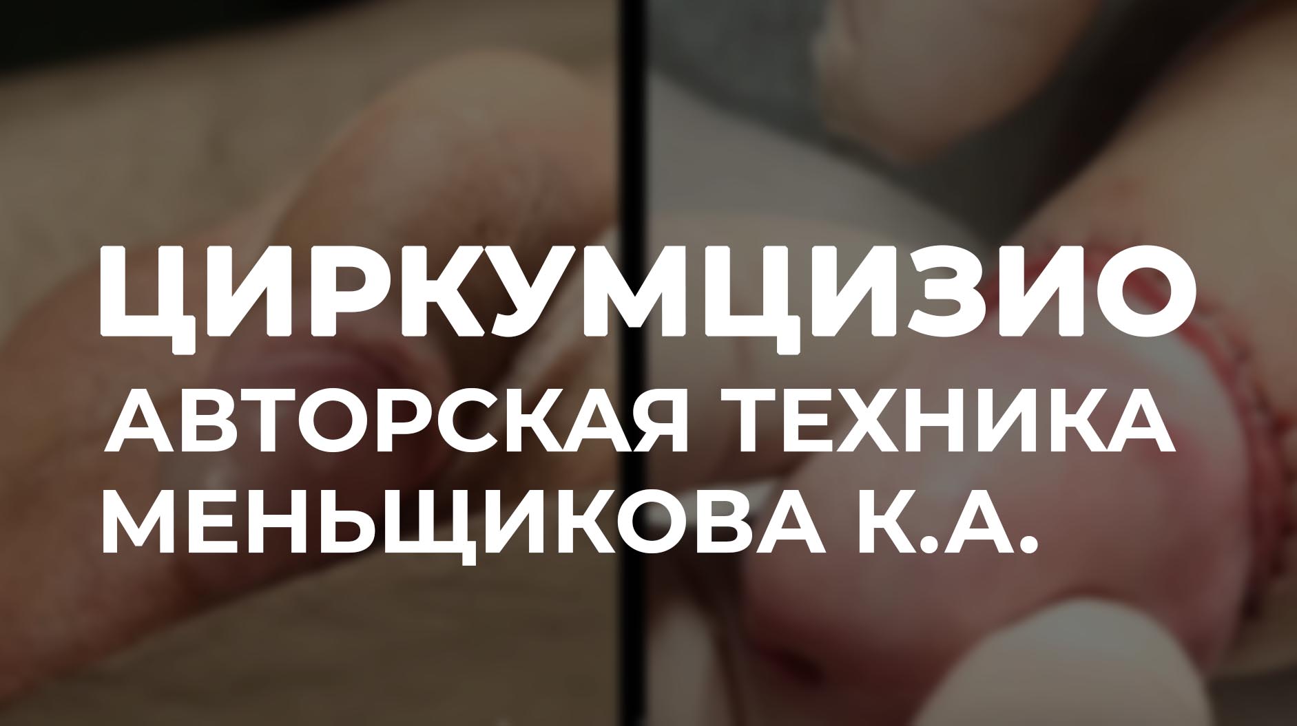 церкумзио видео операции