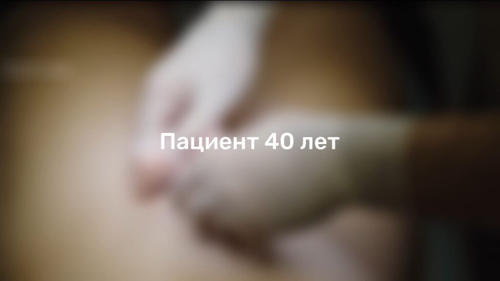 40 Лет - установлен coloplast titan touch видео